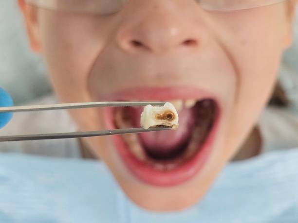 Best Emergency Dental Care for Broken or Chipped Teeth in Cuero, TX